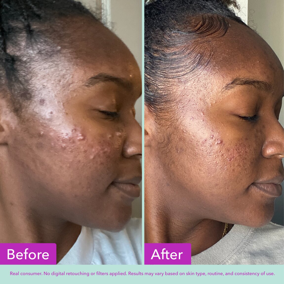 acne-foaming-cleanser-n2 zb_p.jpg